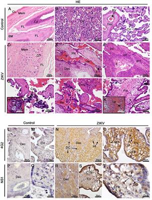 Placental Inflammation and Fetal Injury in a Rare Zika Case Associated With Guillain-Barré Syndrome and Abortion
